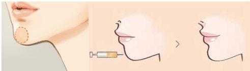 下巴注射玻尿酸以后需要注意什么?