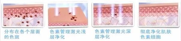 南京做皮秒激光去雀斑要做几次?