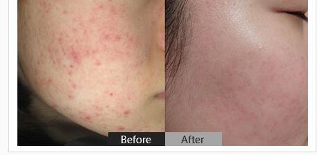 男生用什么方法祛痘印较好?