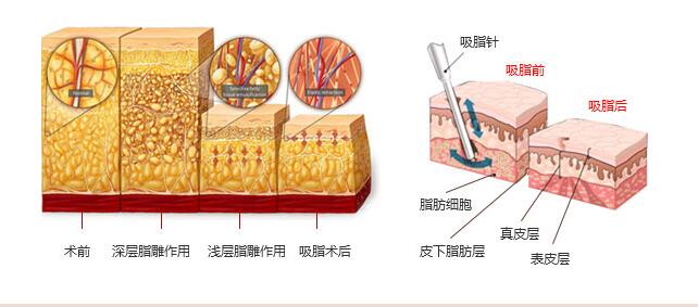 做大腿抽脂手术会有疤痕吗?
