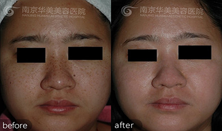 面部的雀斑自己会消失吗