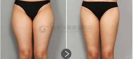 �Ͼ����Ȳ���֬������Ƥ���ɳ���